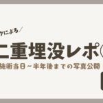 【埋没レポ②】埋没後の腫れはいつ引く？当日〜半年の経過を写真で公開